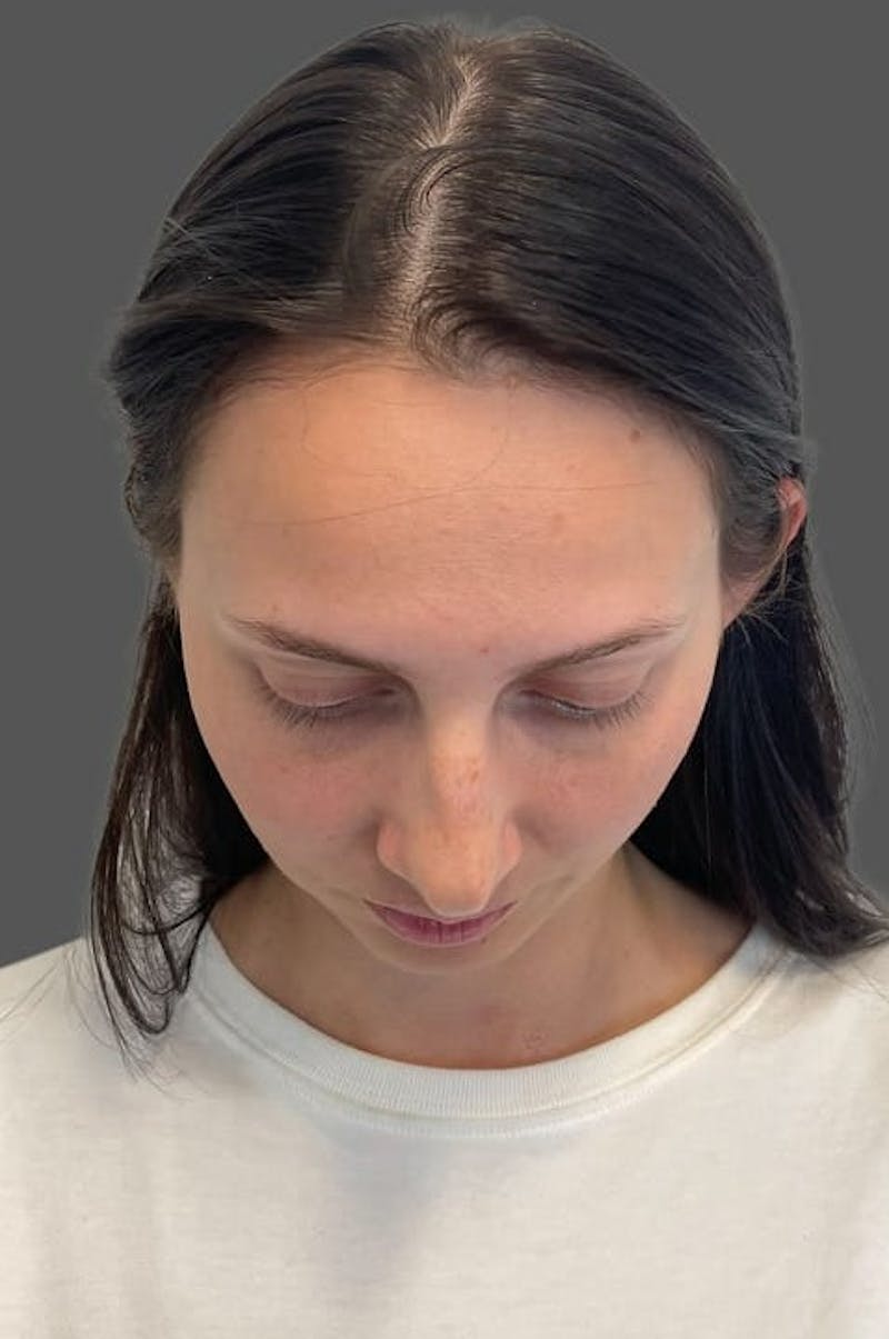 Rhinoplasty Before & After Gallery - Patient 368271 - Image 11