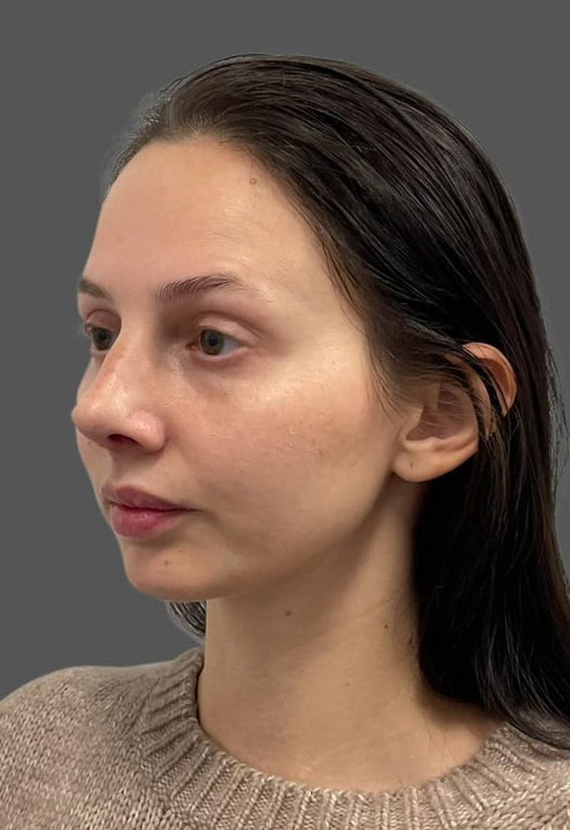 Rhinoplasty Before & After Gallery - Patient 368271 - Image 4