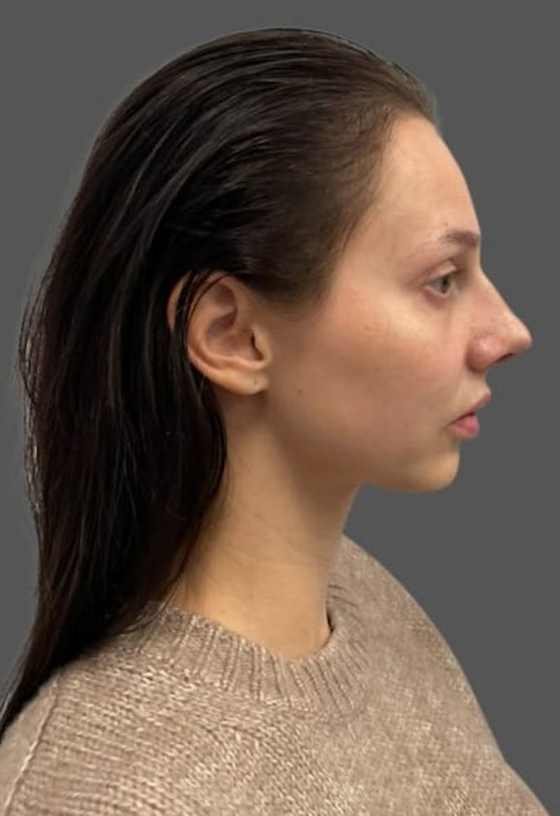 Rhinoplasty Before & After Gallery - Patient 368271 - Image 6