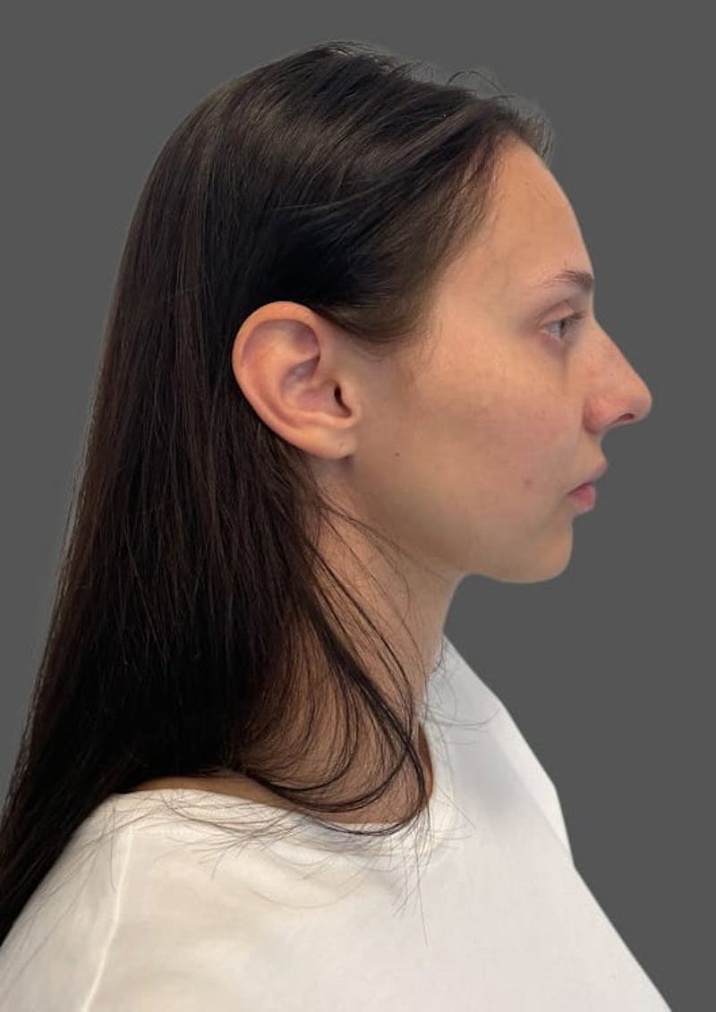 Rhinoplasty Before & After Gallery - Patient 368271 - Image 5