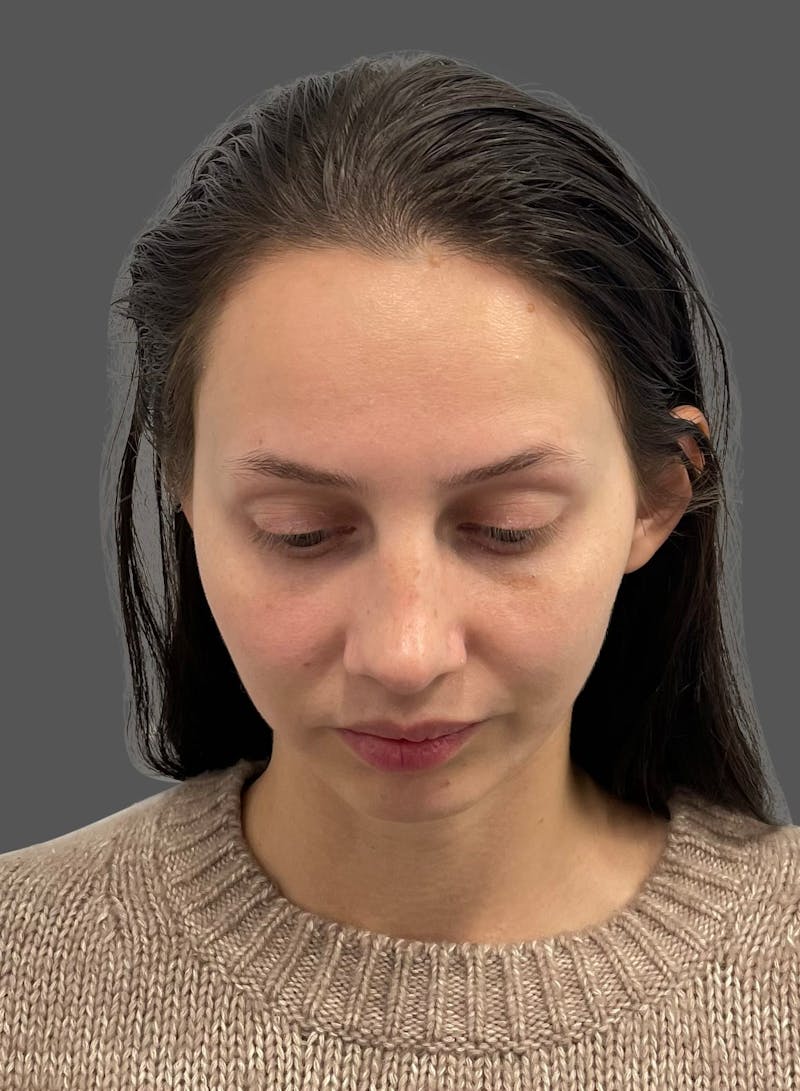 Rhinoplasty Before & After Gallery - Patient 368271 - Image 12