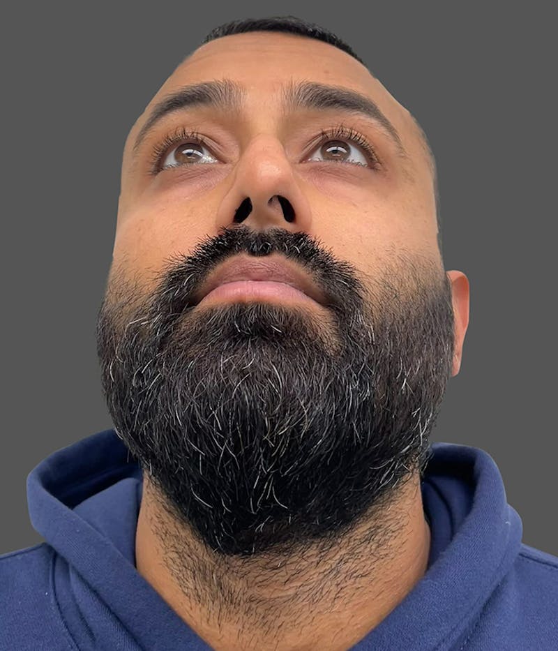 Rhinoplasty Before & After Gallery - Patient 133739 - Image 14