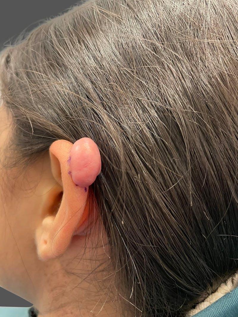 Keloid Removal Before & After Gallery - Patient 332429 - Image 3