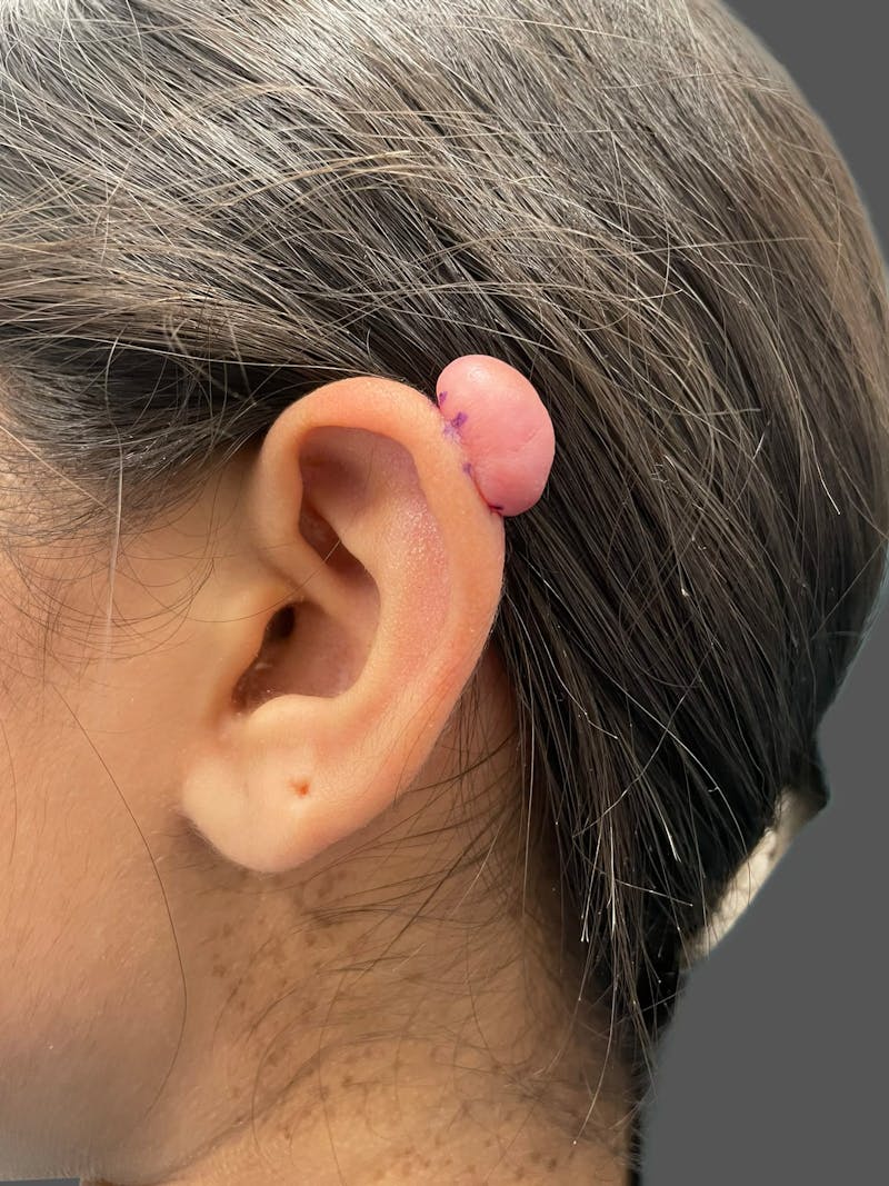 Keloid Removal Before & After Gallery - Patient 332429 - Image 1