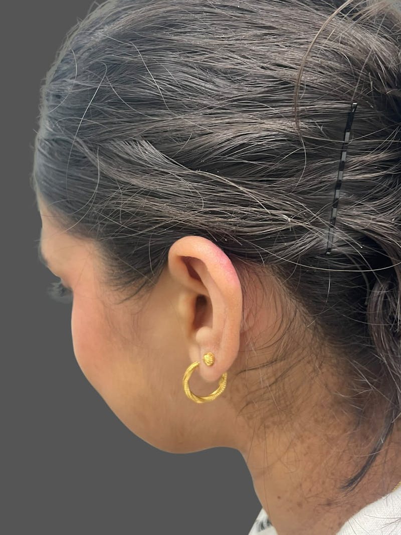 Keloid Removal Before & After Gallery - Patient 332429 - Image 4