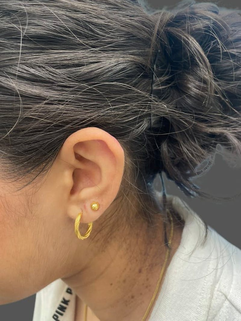 Keloid Removal Before & After Gallery - Patient 332429 - Image 2