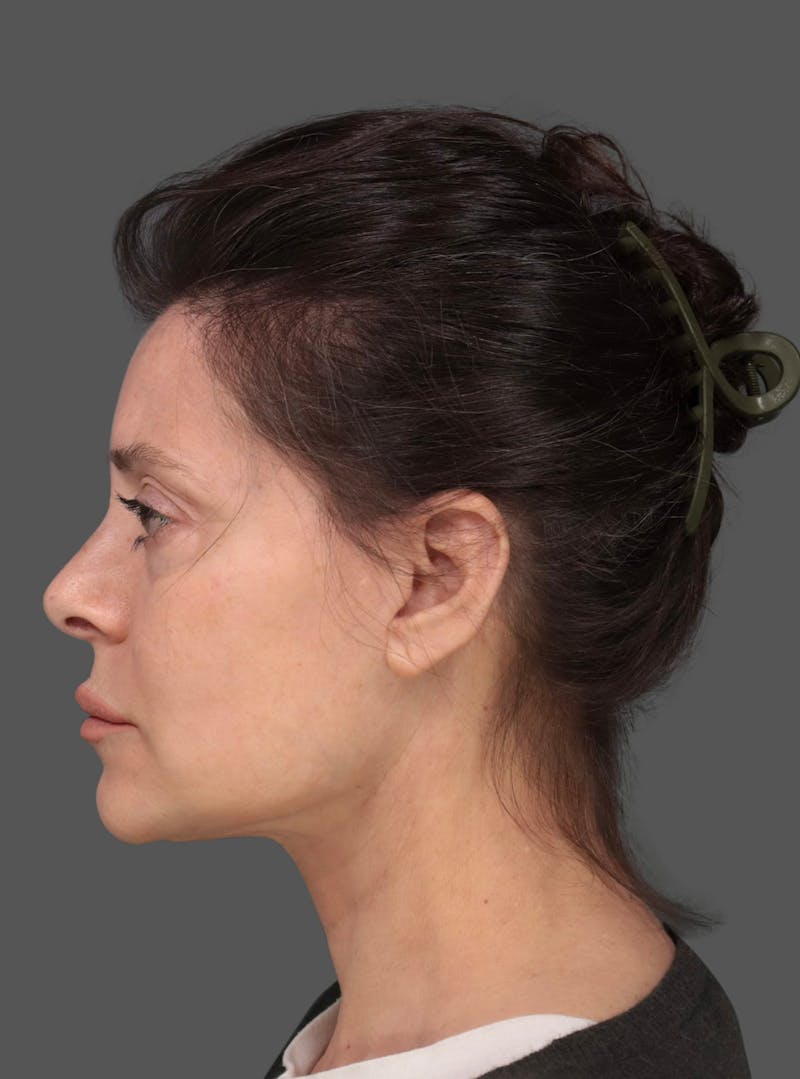 Face & Neck Lift Before & After Gallery - Patient 266106 - Image 2