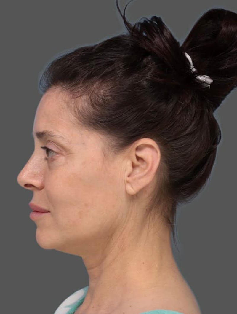 Face & Neck Lift Before & After Gallery - Patient 266106 - Image 1