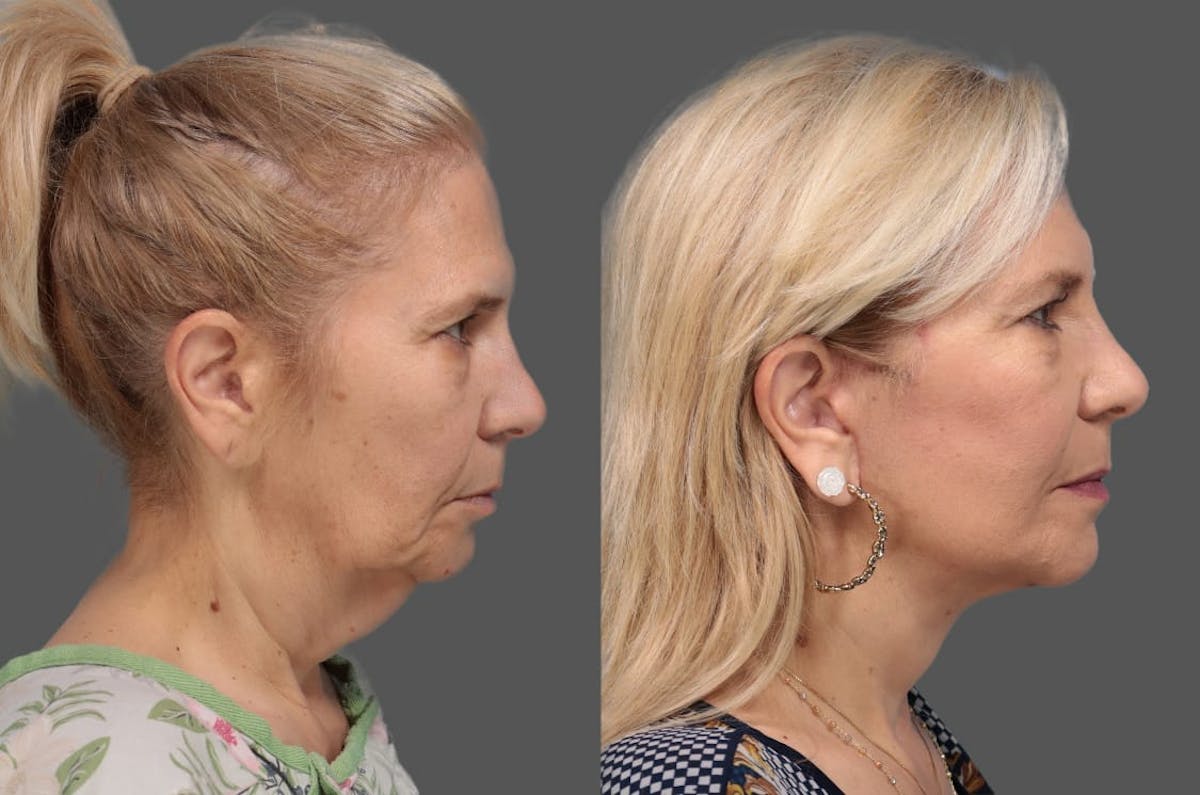 Face & Neck Lift Before & After Gallery - Patient 179715 - Image 4