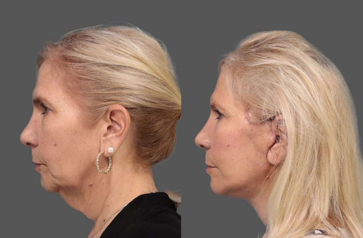 Face & Neck Lift Before & After Gallery - Patient 179715 - Image 2