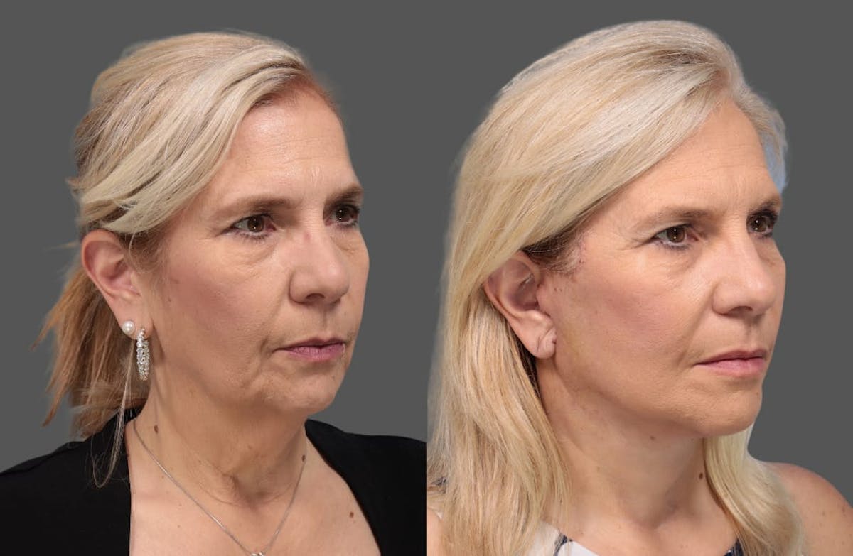 Face & Neck Lift Before & After Gallery - Patient 179715 - Image 3