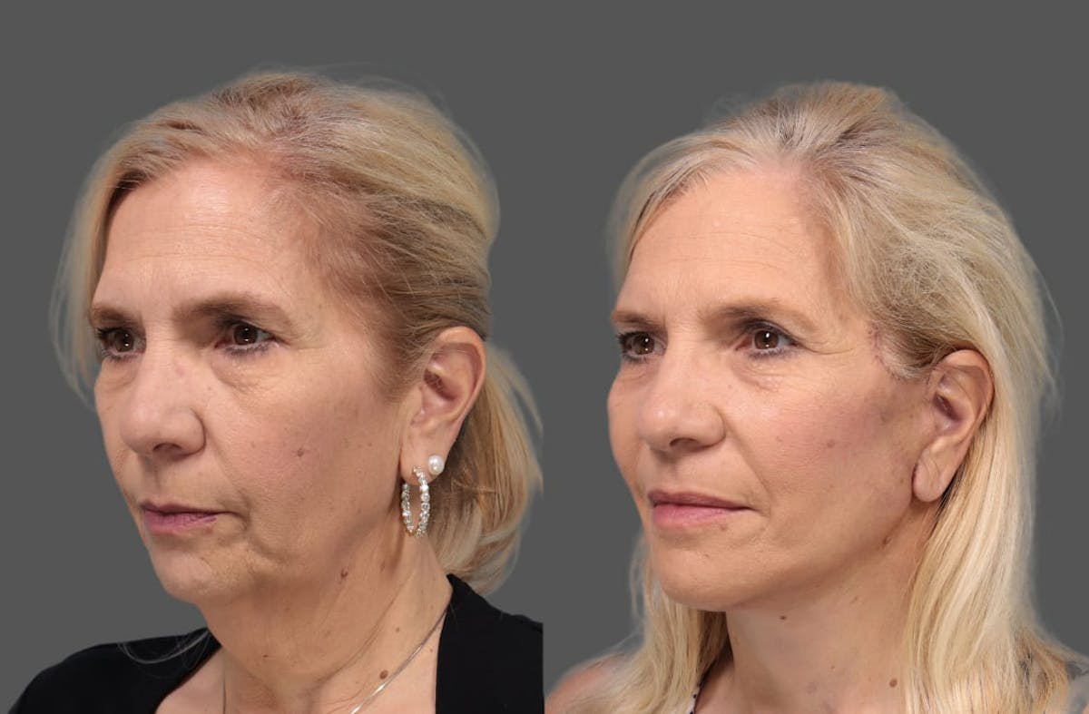 Face & Neck Lift Before & After Gallery - Patient 179715 - Image 1