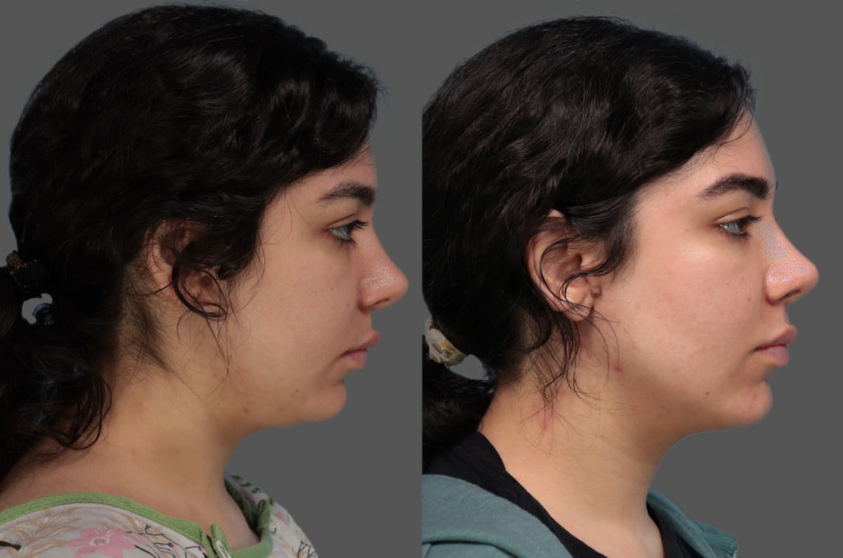 FaceTite Before & After Gallery - Patient 145536 - Image 2