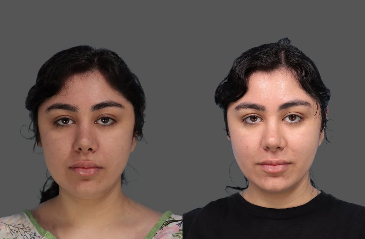 FaceTite Before & After Gallery - Patient 145536 - Image 3
