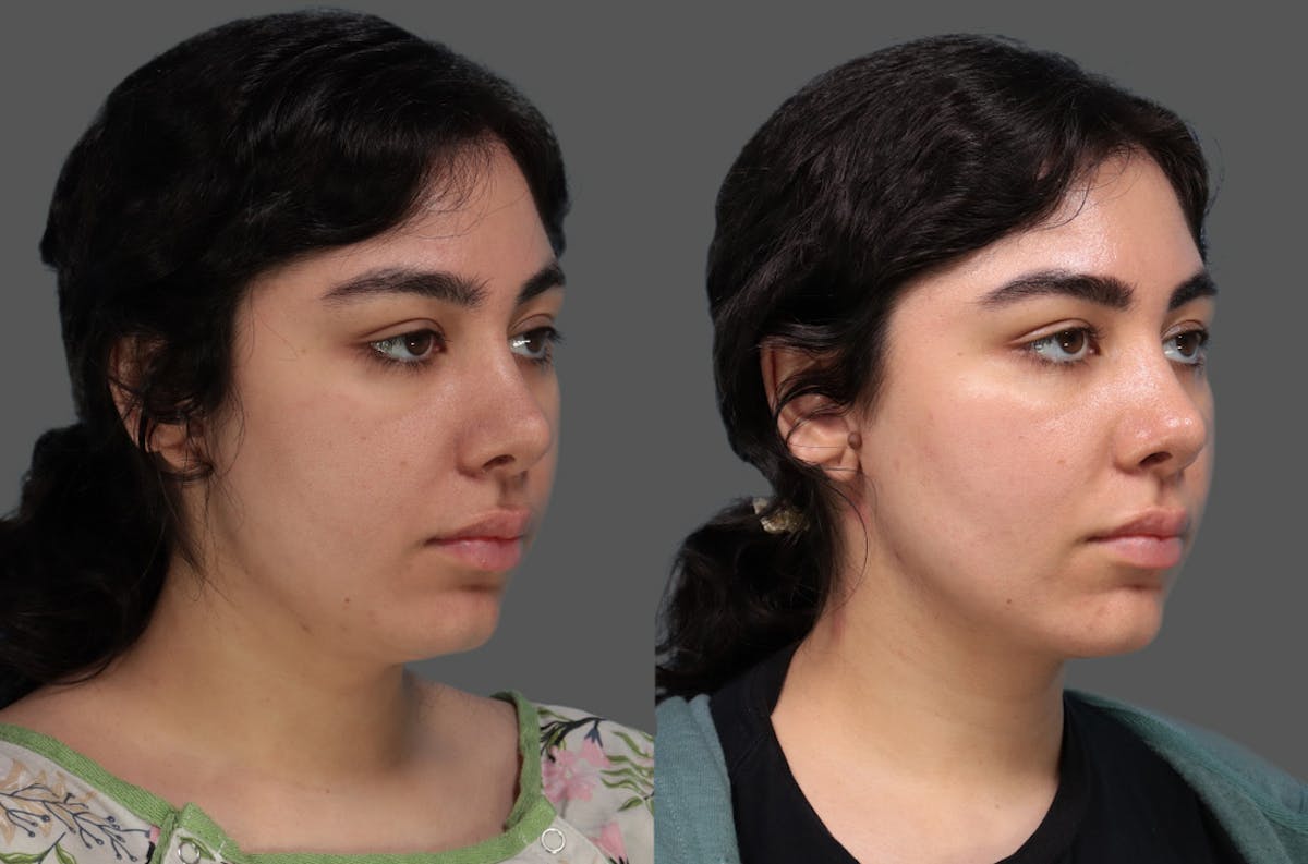 FaceTite Before & After Gallery - Patient 145536 - Image 1