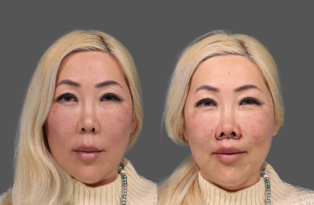 Lip Lift Before & After Gallery - Patient 261600 - Image 1