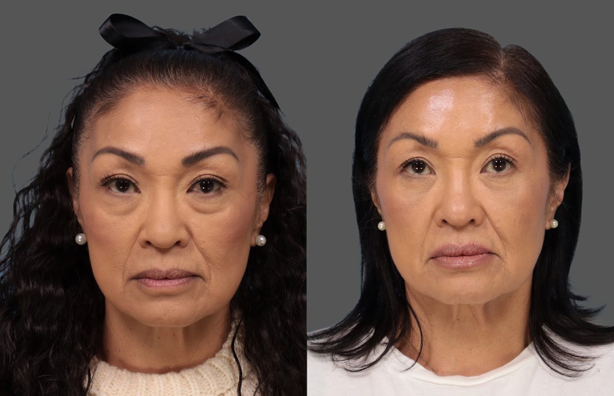 Lower Blepharoplasty Before & After Gallery - Patient 224120 - Image 1