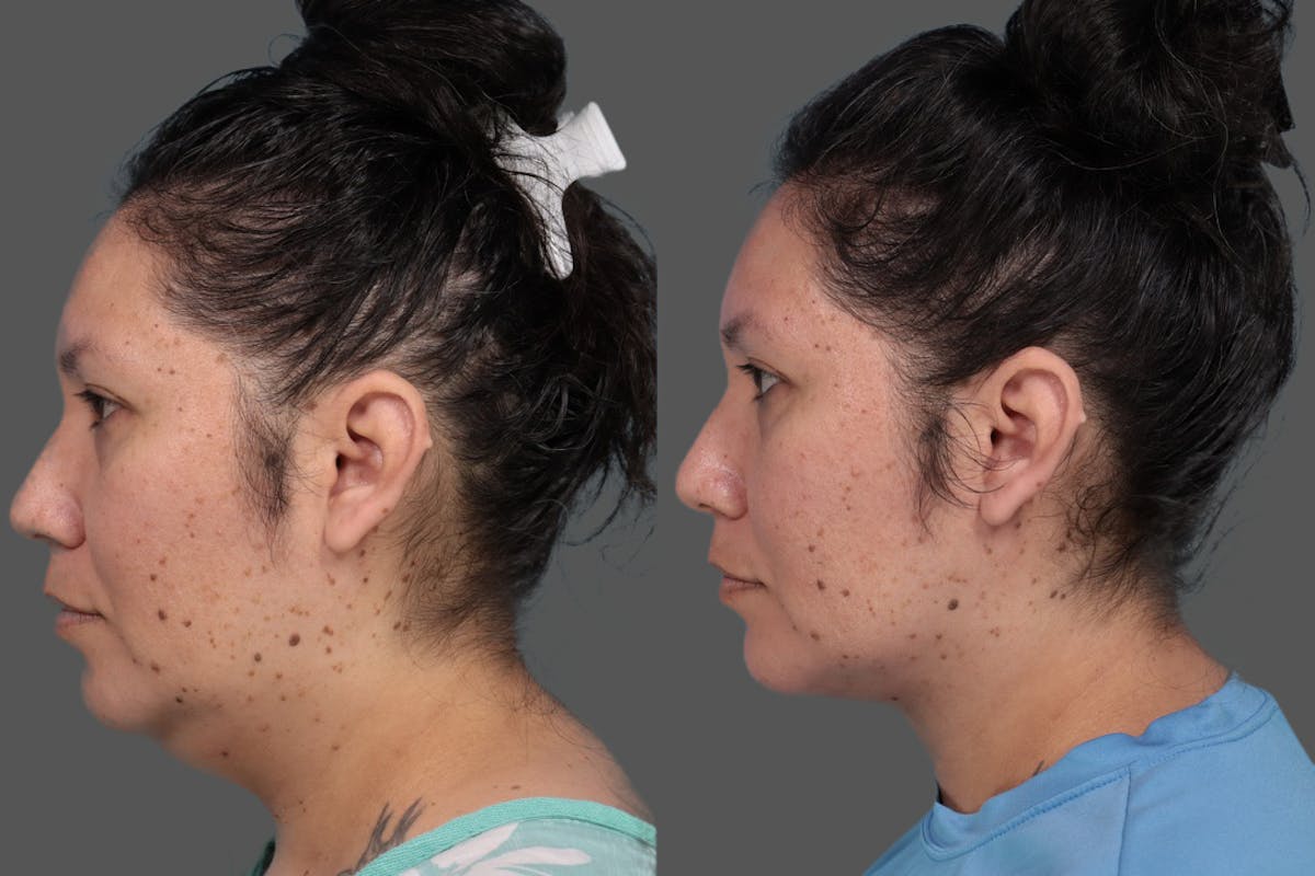 Midline Necklift Before & After Gallery - Patient 189628 - Image 1