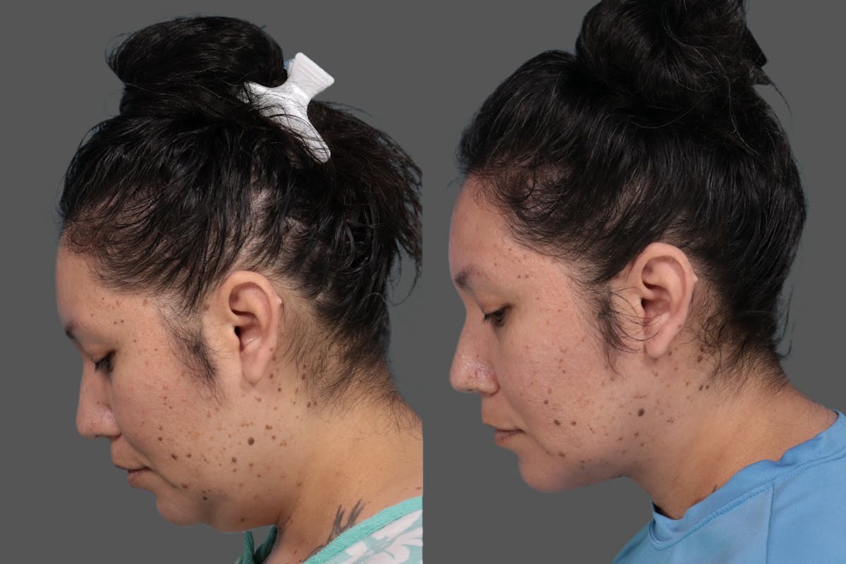 Midline Necklift Before & After Gallery - Patient 189628 - Image 3