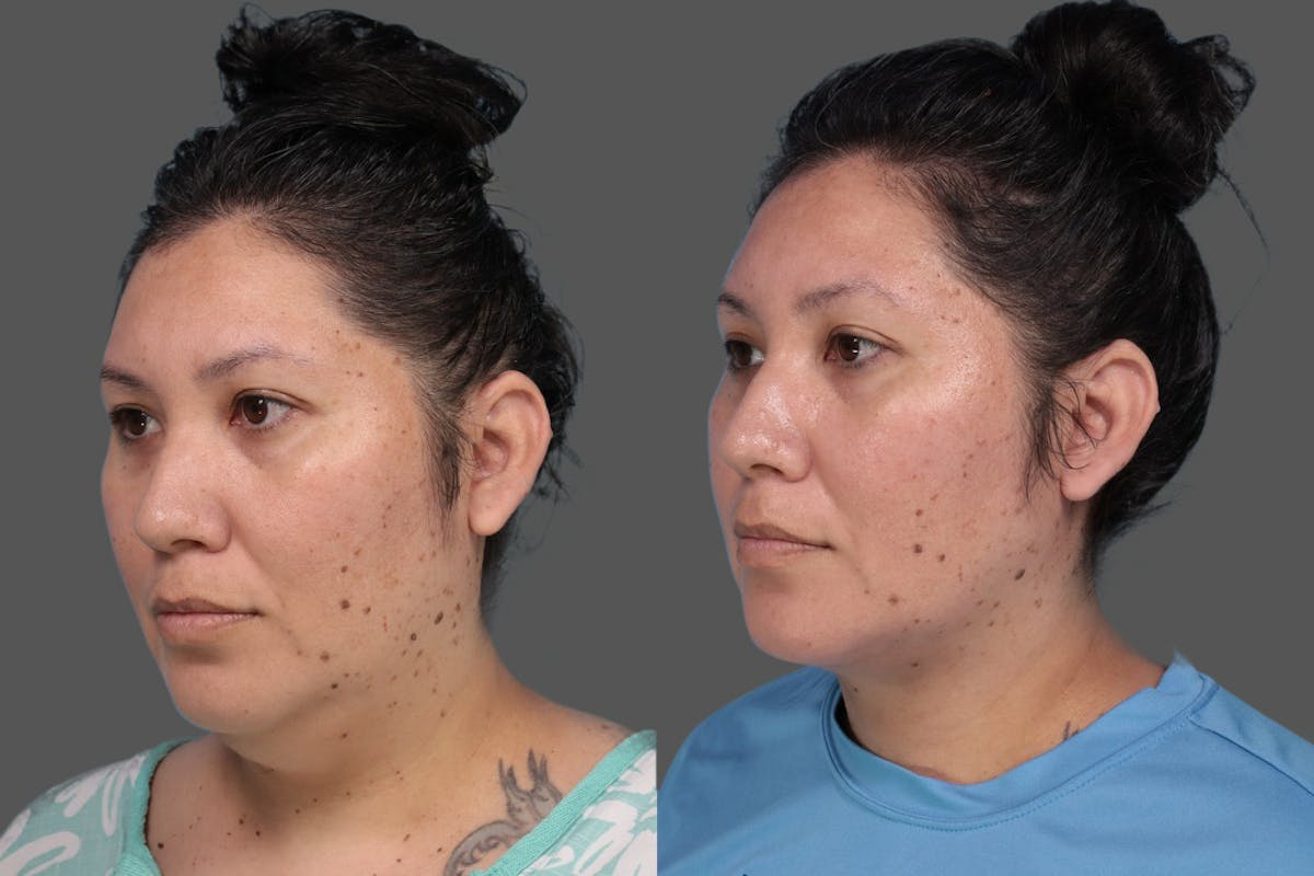 Midline Necklift Before & After Gallery - Patient 189628 - Image 2