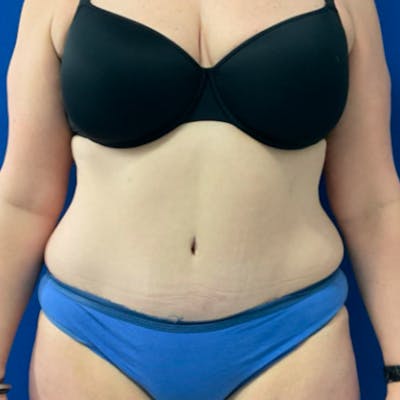 Tummy Tuck Before & After Gallery - Patient 876613 - Image 2