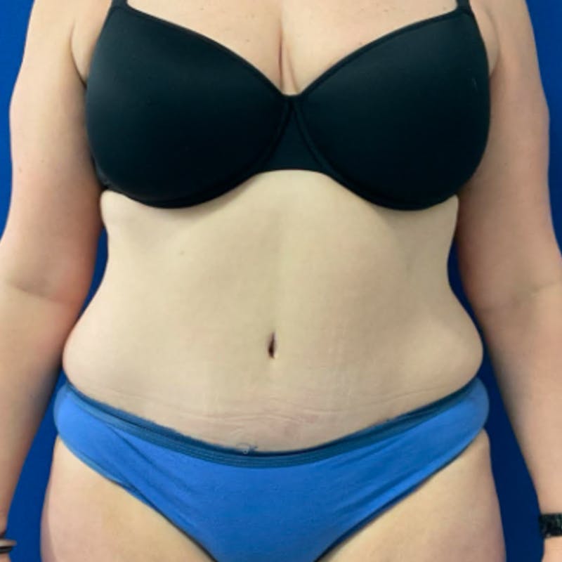 Tummy Tuck Before & After Gallery - Patient 876613 - Image 2