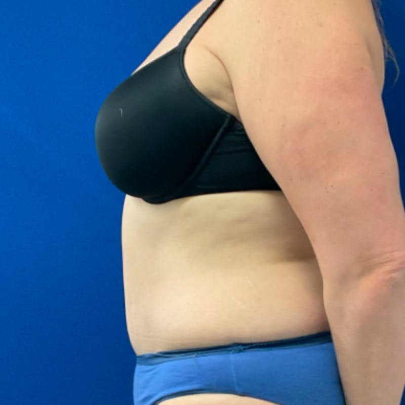 Tummy Tuck Before & After Gallery - Patient 876613 - Image 6
