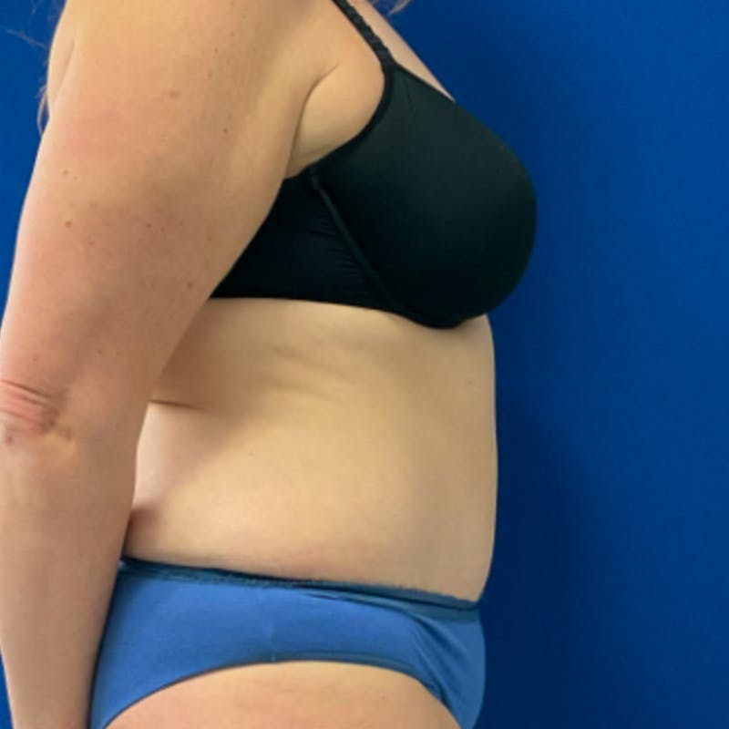 Tummy Tuck Before & After Gallery - Patient 876613 - Image 4