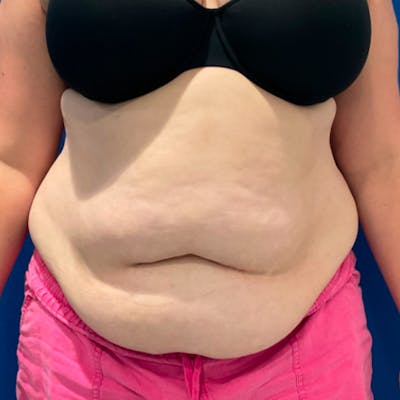 Tummy Tuck Before & After Gallery - Patient 876613 - Image 1