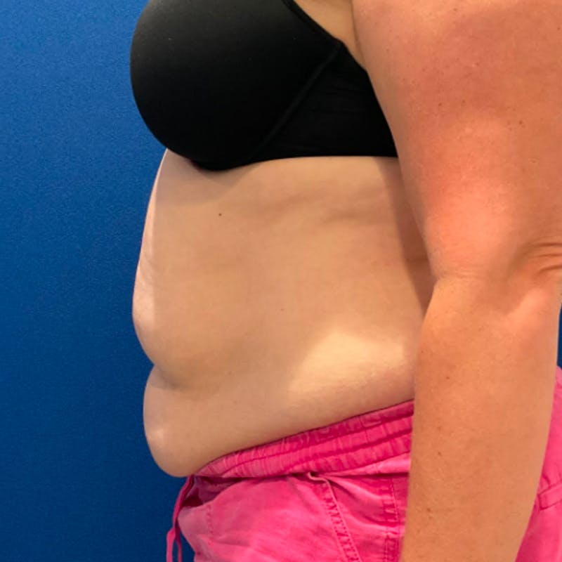Tummy Tuck Before & After Gallery - Patient 876613 - Image 5