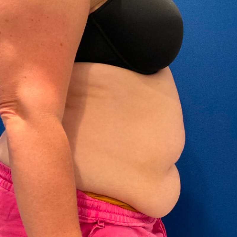 Tummy Tuck Before & After Gallery - Patient 876613 - Image 3