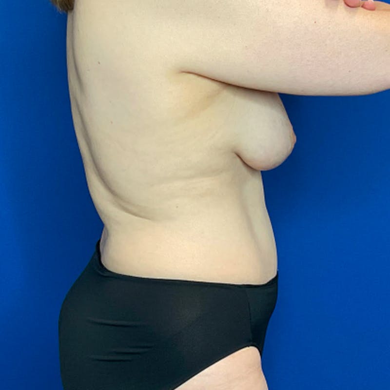 Tummy Tuck Before & After Gallery - Patient 400838 - Image 4
