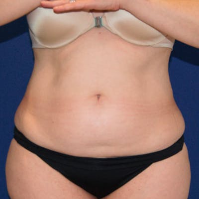 Tummy Tuck Before & After Gallery - Patient 400838 - Image 1