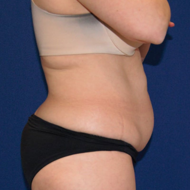 Tummy Tuck Before & After Gallery - Patient 400838 - Image 3