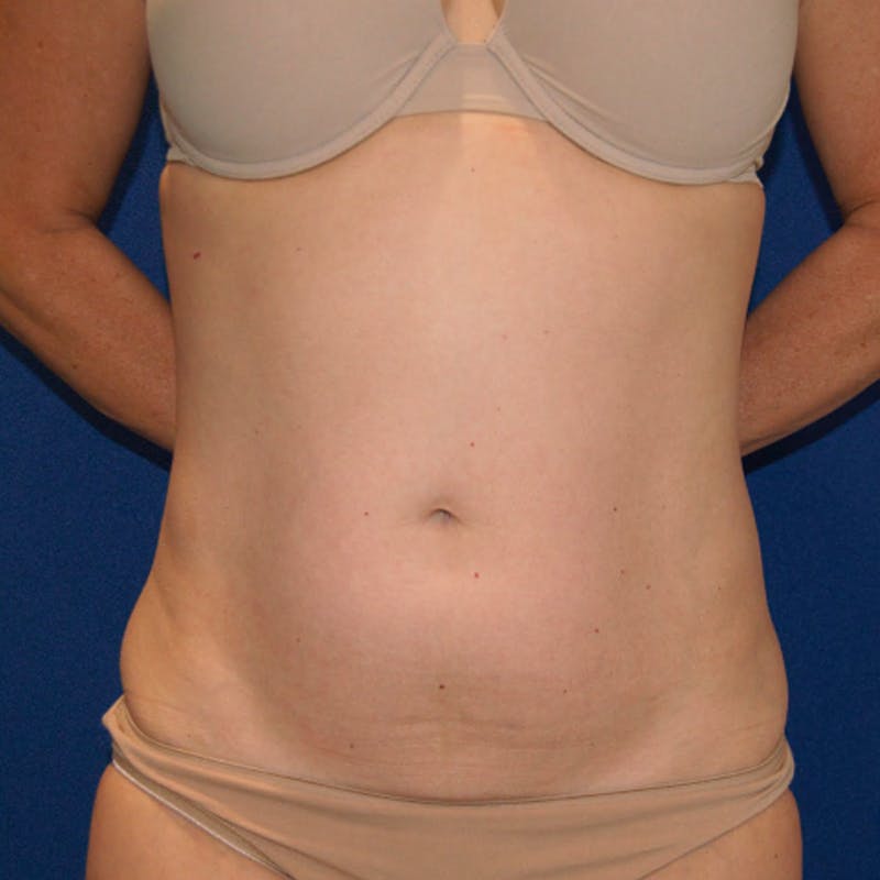 Tummy Tuck Before & After Gallery - Patient 682396 - Image 1