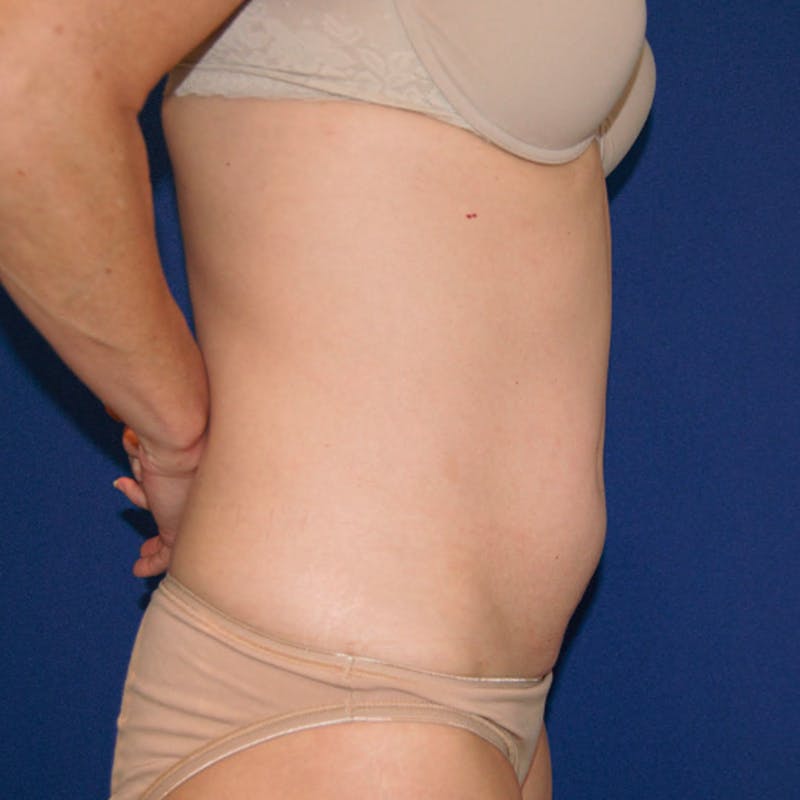 Tummy Tuck Before & After Gallery - Patient 682396 - Image 3