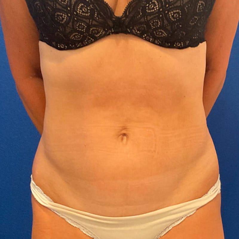Tummy Tuck Before & After Gallery - Patient 337759 - Image 1
