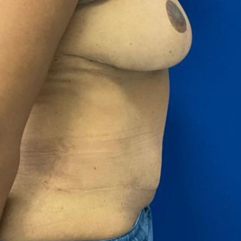 Tummy Tuck Before & After Gallery - Patient 626674 - Image 4