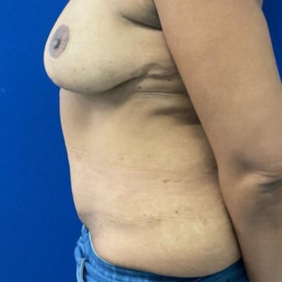 Tummy Tuck Before & After Gallery - Patient 626674 - Image 2