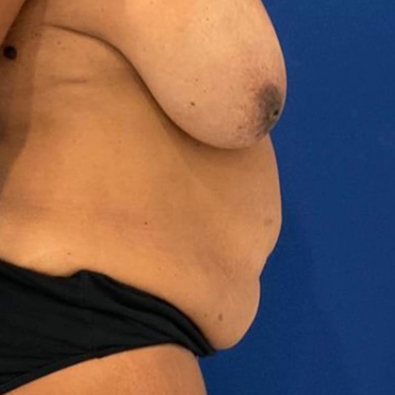 Tummy Tuck Before & After Gallery - Patient 626674 - Image 3