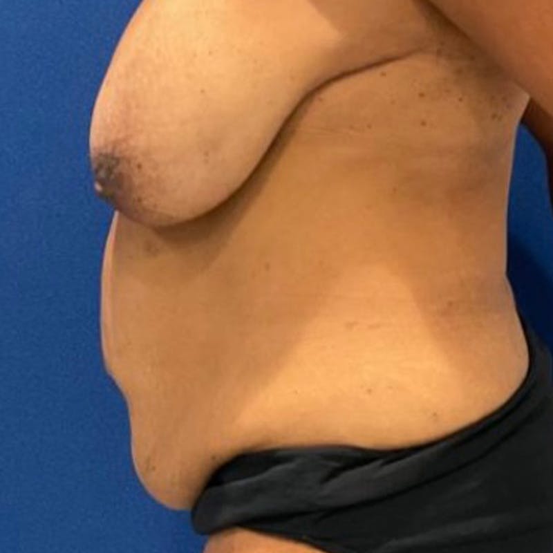 Tummy Tuck Before & After Gallery - Patient 626674 - Image 1