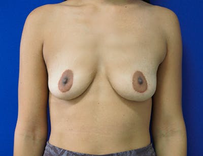 Breast Augmentation Before & After Gallery - Patient 368044 - Image 1