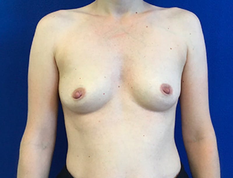 Breast Augmentation Before & After Gallery - Patient 277562 - Image 1