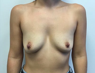 Breast Augmentation Before & After Gallery - Patient 291387 - Image 1