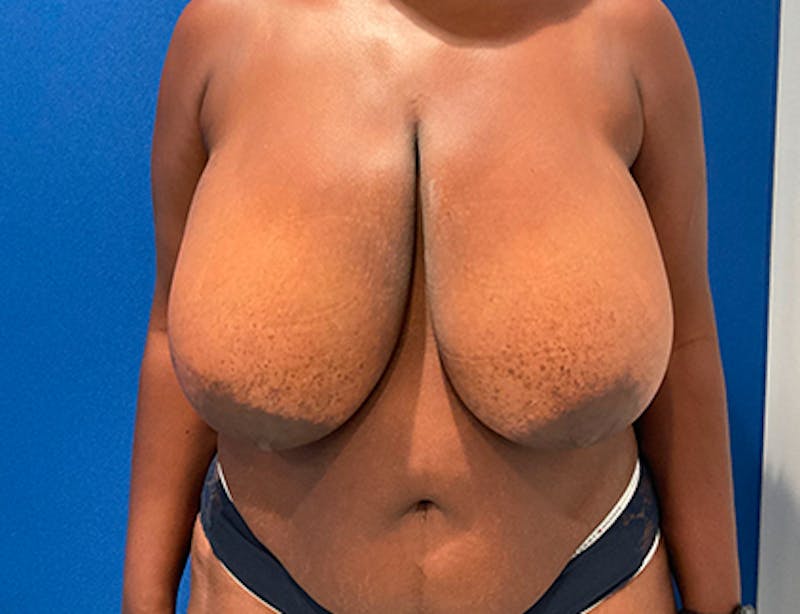 Breast Reduction Before & After Gallery - Patient 237855 - Image 1