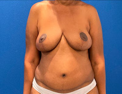 Breast Reduction Before & After Gallery - Patient 581349 - Image 2