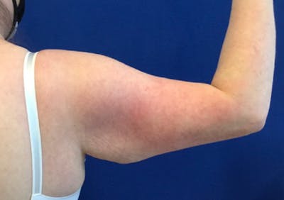 Arm Lift Before & After Gallery - Patient 350008 - Image 1