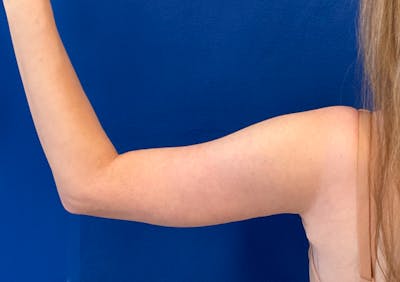 Arm Lift Before & After Gallery - Patient 350008 - Image 2