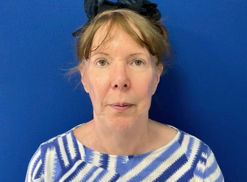Neck Lift Before & After Gallery - Patient 238882 - Image 4