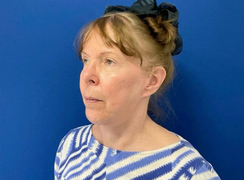Neck Lift Before & After Gallery - Patient 238882 - Image 2